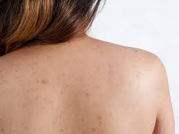 Pimples on the back too!